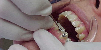 Лечение и протезирование зубов в Китае